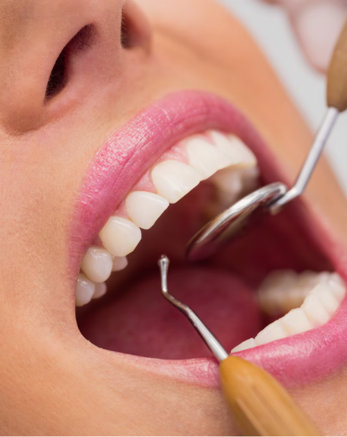 Professionelle Zahnreinigung Professionelle Zahnreinigung