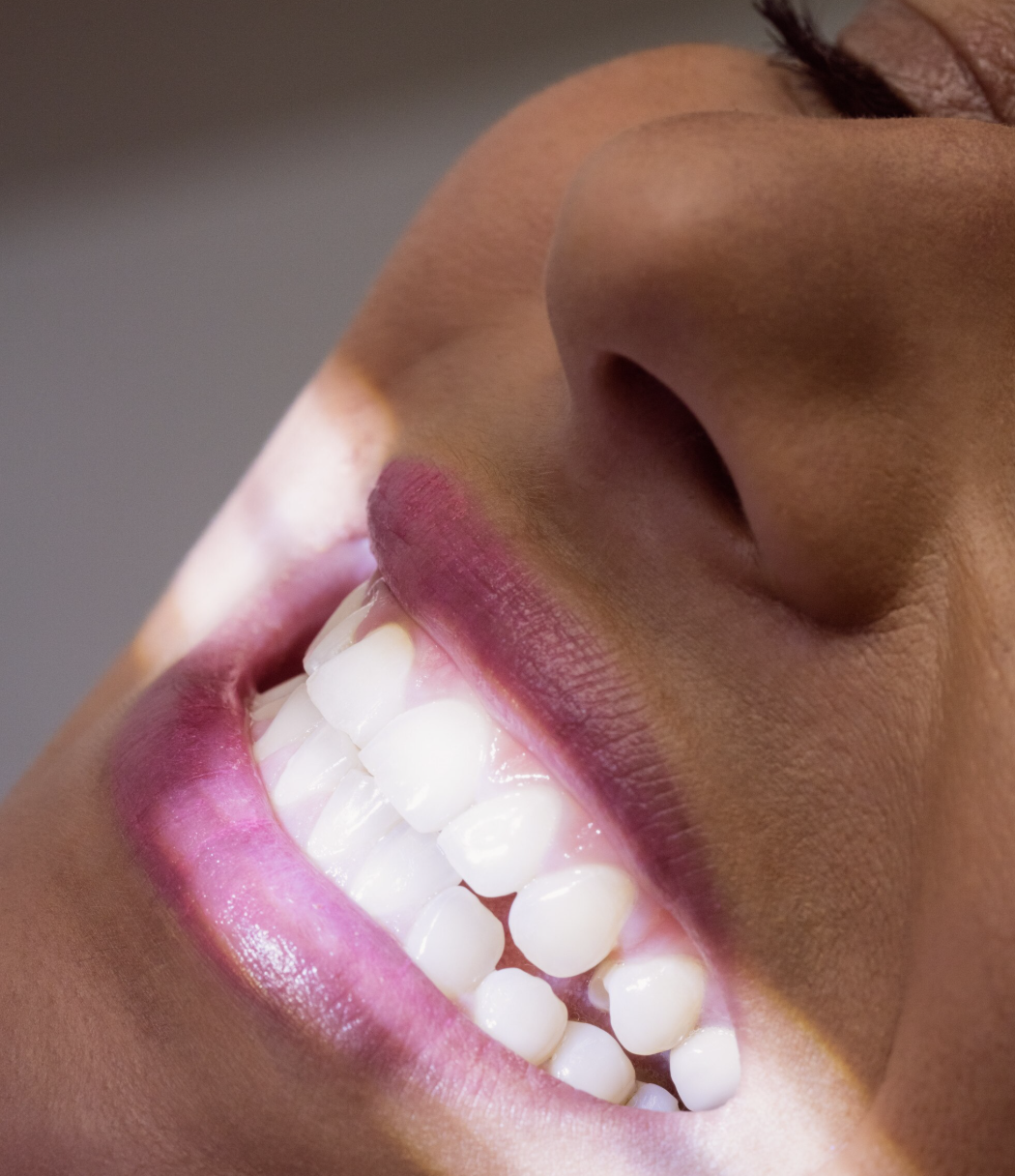 Verblendschalen Veneers bei Zahnarzt Dr Borkowski Verblendschalen Veneers bei Zahnarzt Dr Borkowski